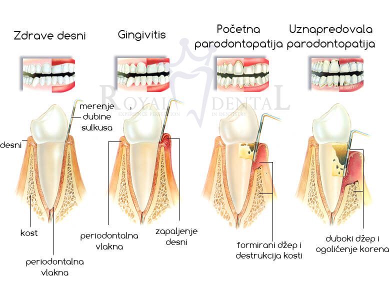 Razvoj parodontopatije