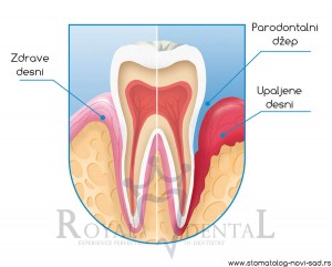 Krvarenje desni je prvi simptom oboljenja parodoncijuma
