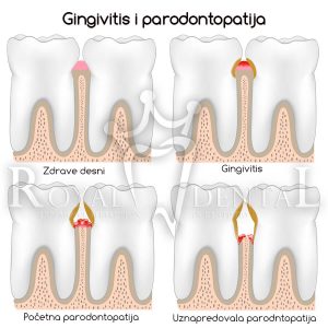 gingivitis i parodontopatija