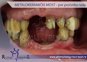 Slika 1. Pre izrade metalokermičkog mosta