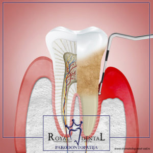 Uklanjanje zubnog kamenca i mekih naslaga sprečava nastanak parodontopatije
