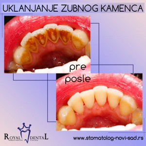 Zubni kamenac - pre i posle